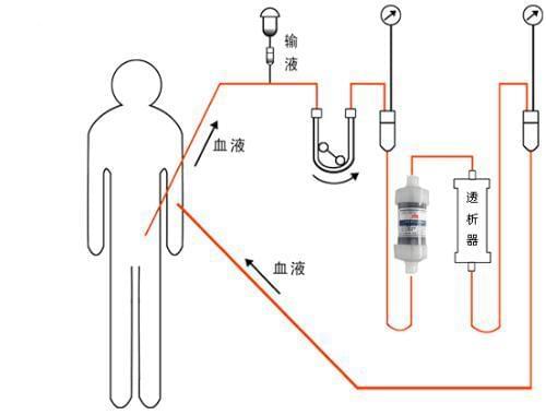 【前沿科技】揭秘植入式人工肾最新进展与突破动态